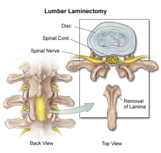 lumbar-laminectomy